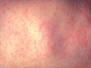 继台湾、日本之后　美国纽约州也发布麻疹疫情警告